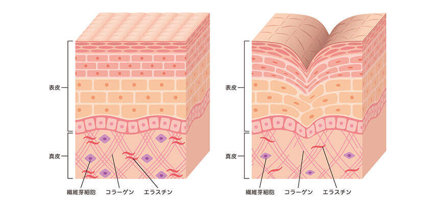 しわは皮膚の谷間